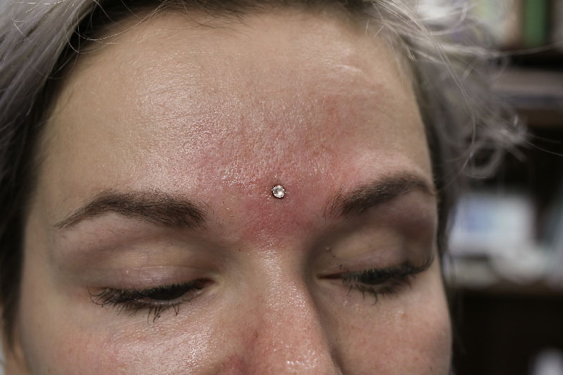 microdermal