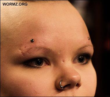 Microdermal